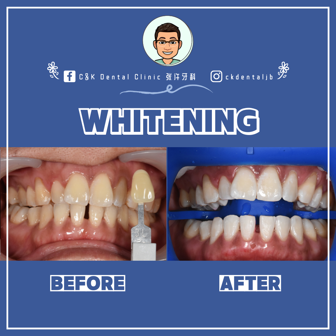 Wisdom Tooth